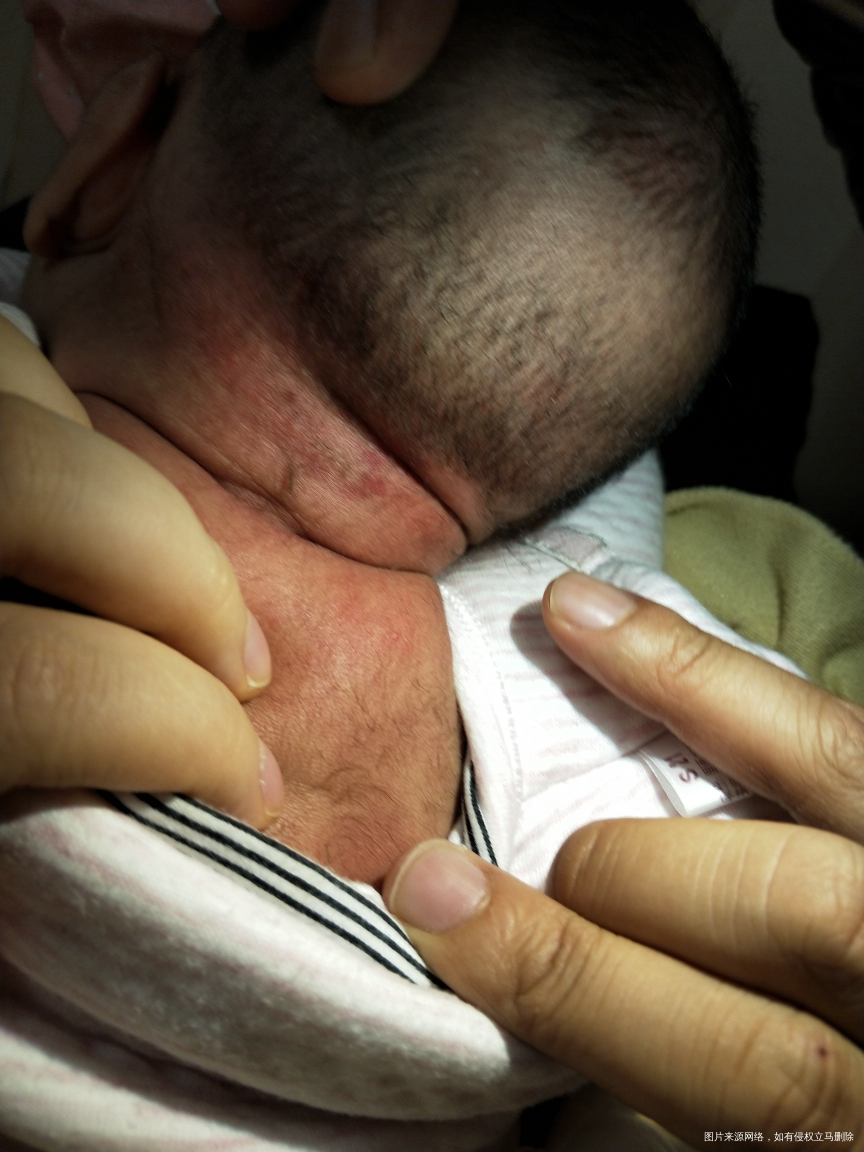 麻烦医生看下,宝宝身上和头上这是湿疹吗?