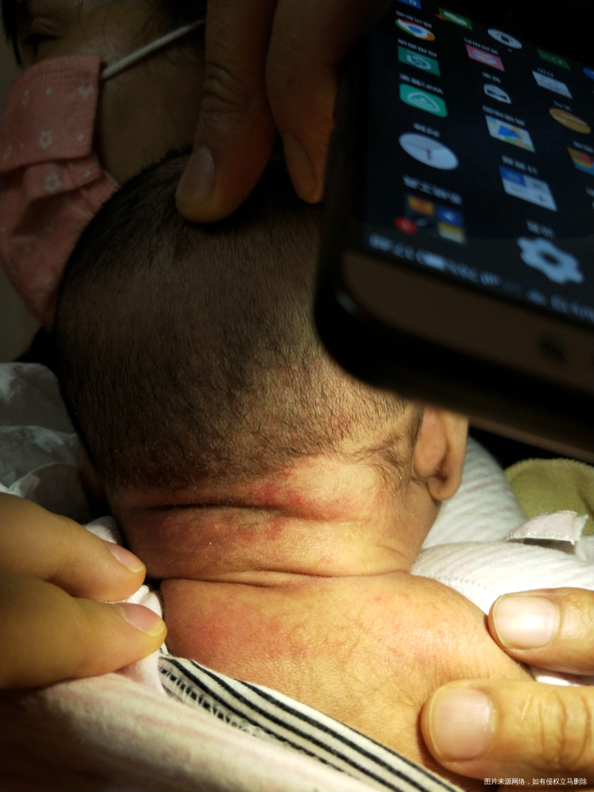 麻烦医生看下,宝宝身上和头上这是湿疹吗?
