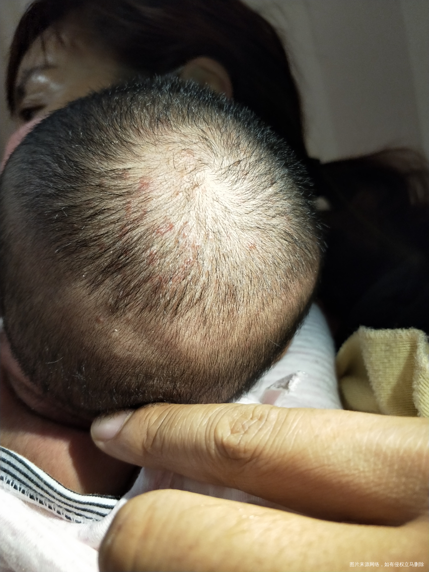 麻烦医生看下,宝宝身上和头上这是湿疹吗?