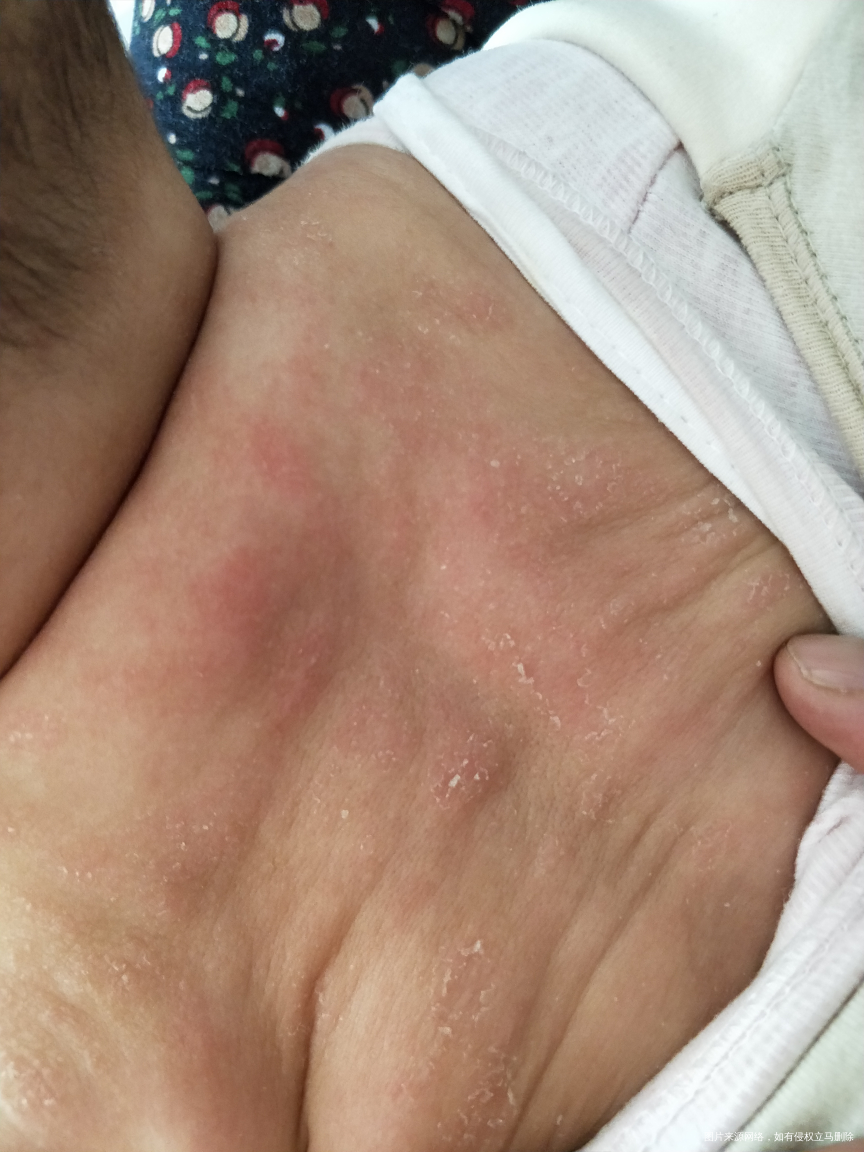 麻烦医生看下4月宝宝身上是什么