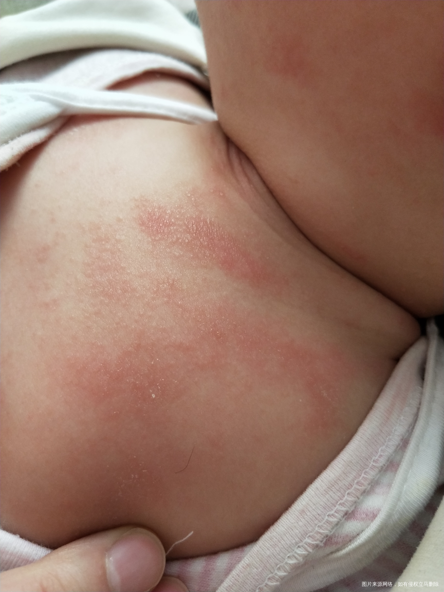 麻烦医生看下4月宝宝身上是什么