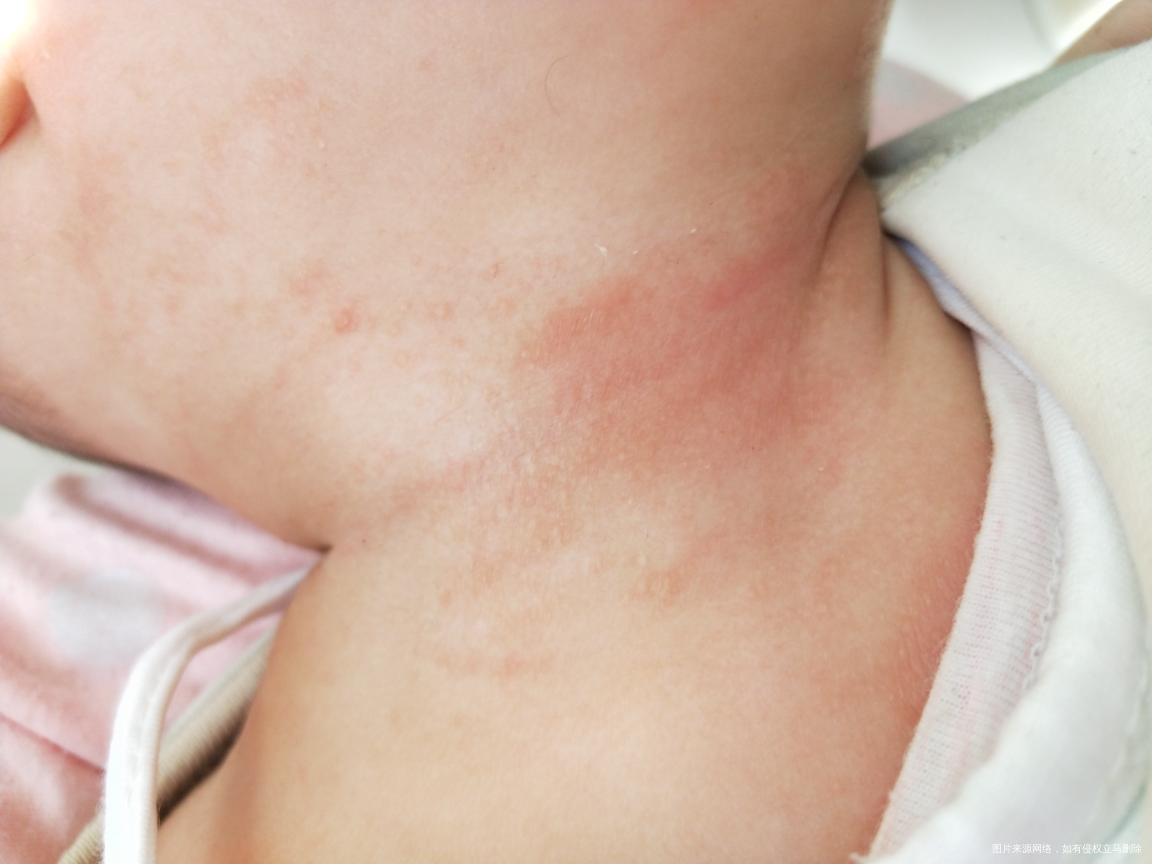 麻烦医生看下4月宝宝身上是什么