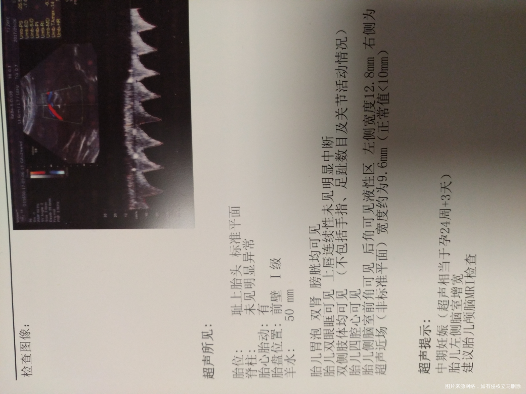 孕24周+,有脑积水的可能怎么办