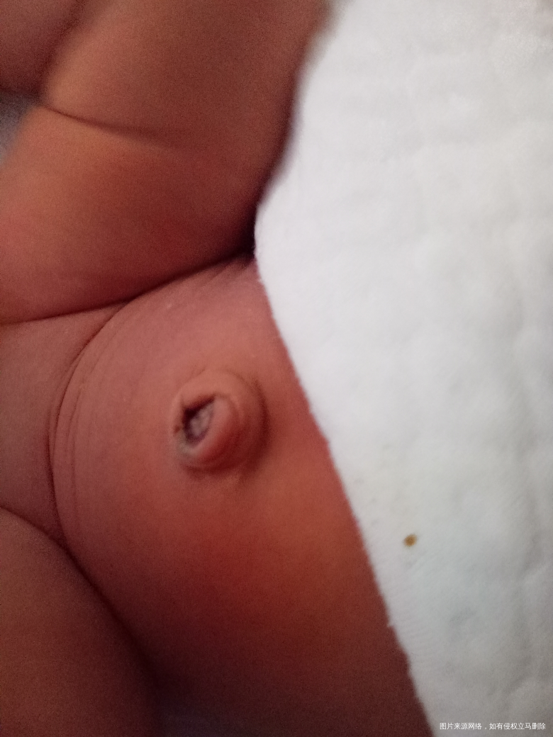 请医生 看看宝宝肚脐正常吗?