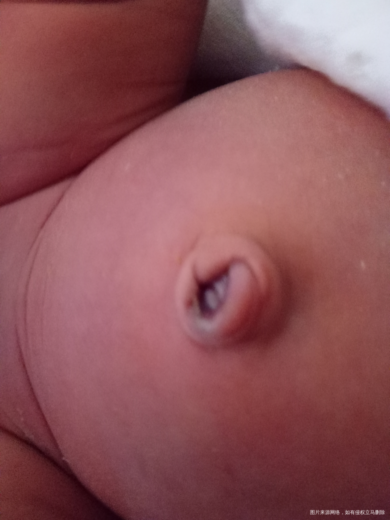 请医生 看看宝宝肚脐正常吗?