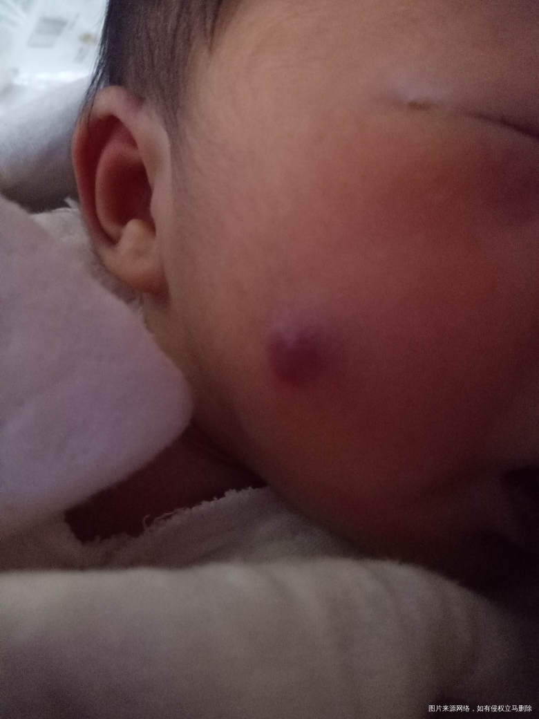 医生看看宝宝脸上是血管瘤吗?