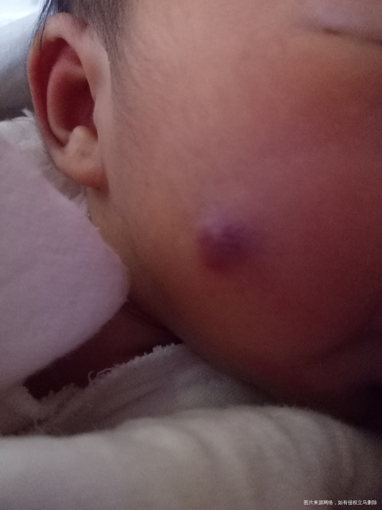 医生看看宝宝脸上是血管瘤吗?
