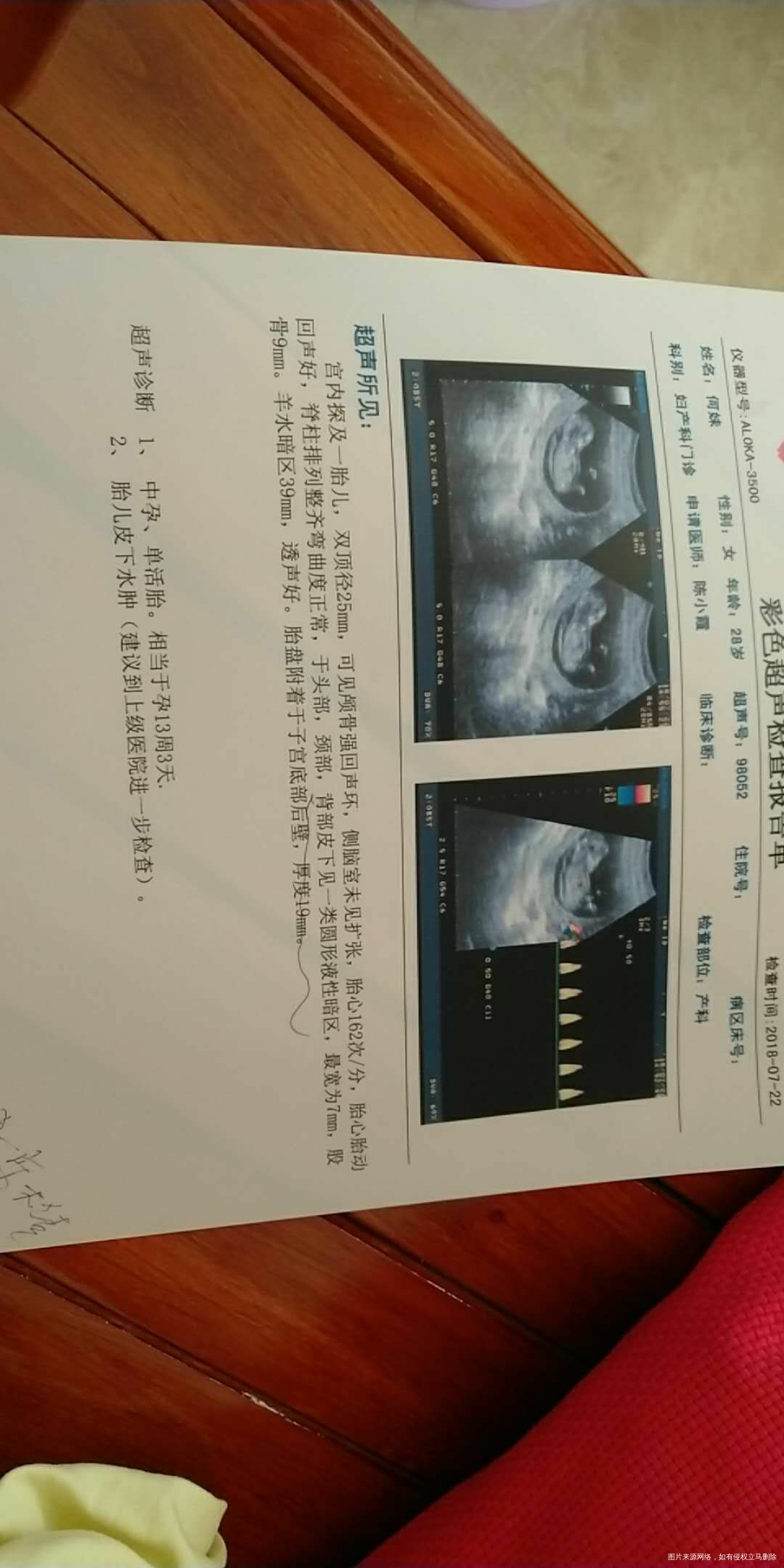今天去医院做NT医生说 胎儿皮下水肿 叫明天在去大医院看看 ...
