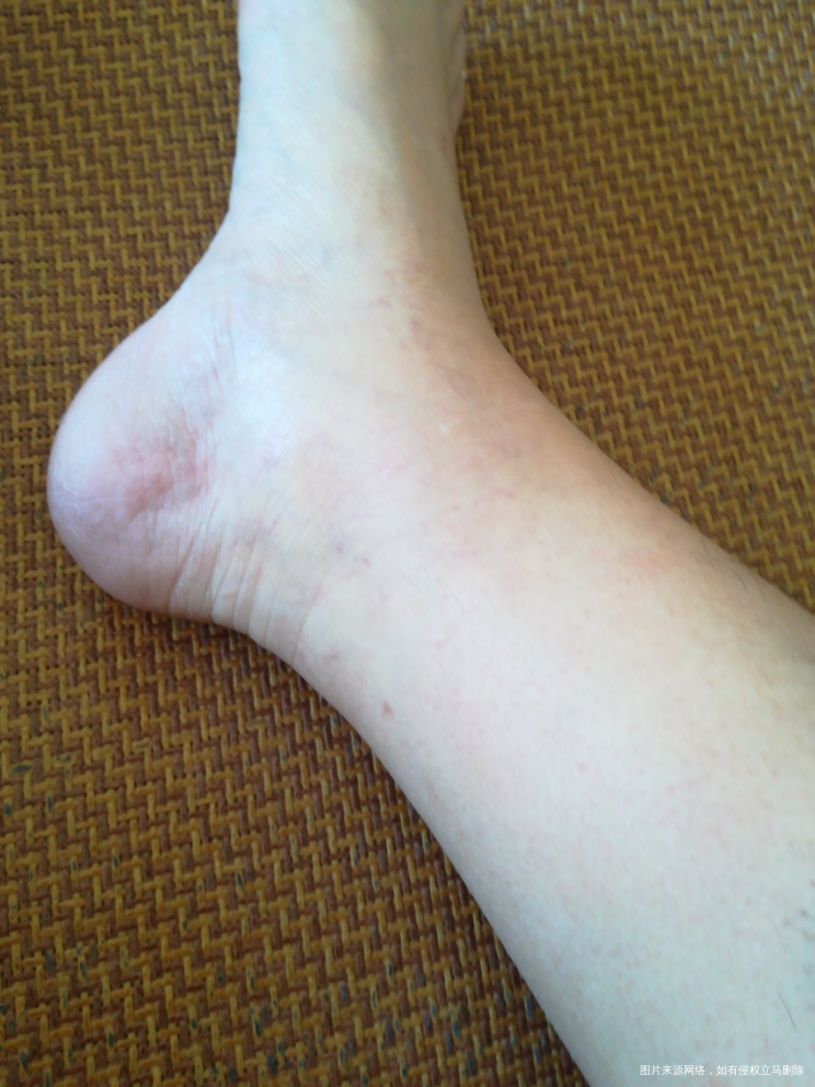 一直以为我的脚不会肿了,因为之前一直还好,昨天下午还是别人提醒我问我脚怎么回事,...