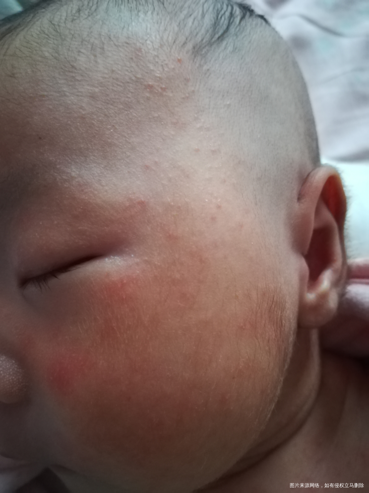 刚满月的宝宝脸上脖子一圈起了好多疹子