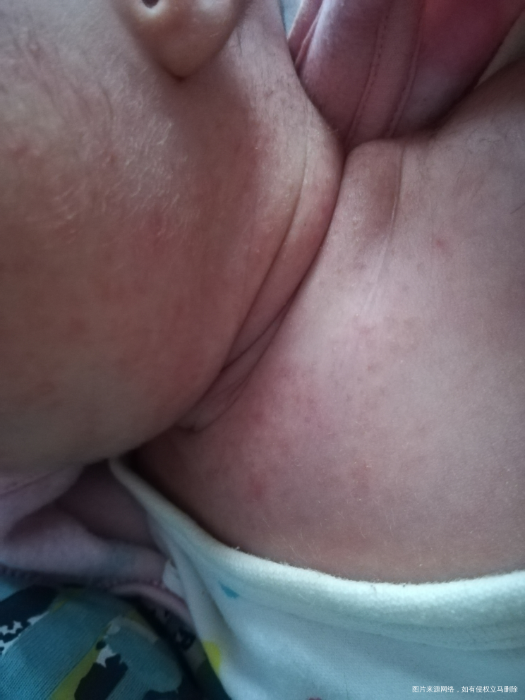 刚满月的宝宝脸上脖子一圈起了好多疹子