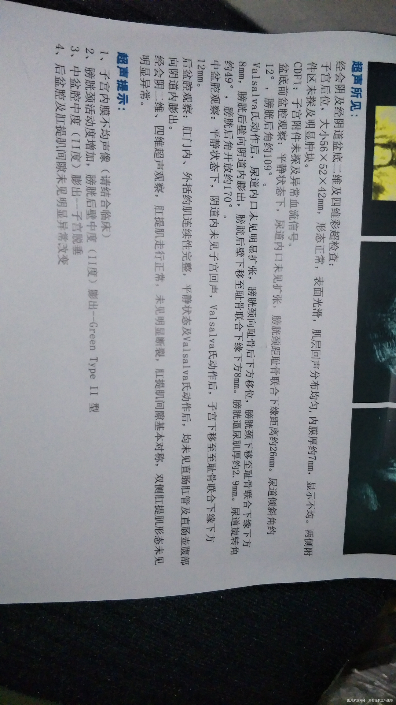 顺产42天复查,子宫脱垂