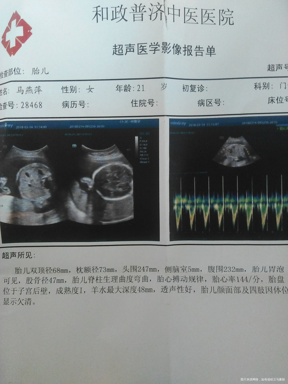 27周了,最近老是恶心,医生给看看彩超正不正常