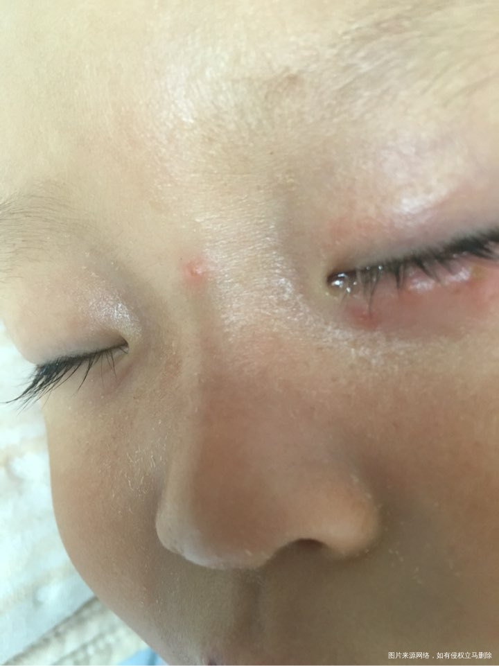 有在线的医生帮忙看看,宝宝眼睑下起的是什么疙瘩