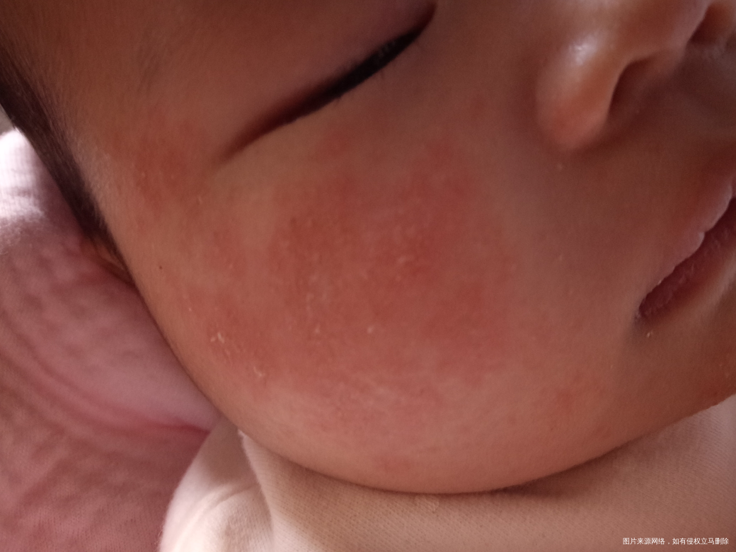 45天的宝宝脸上是湿疹吗?