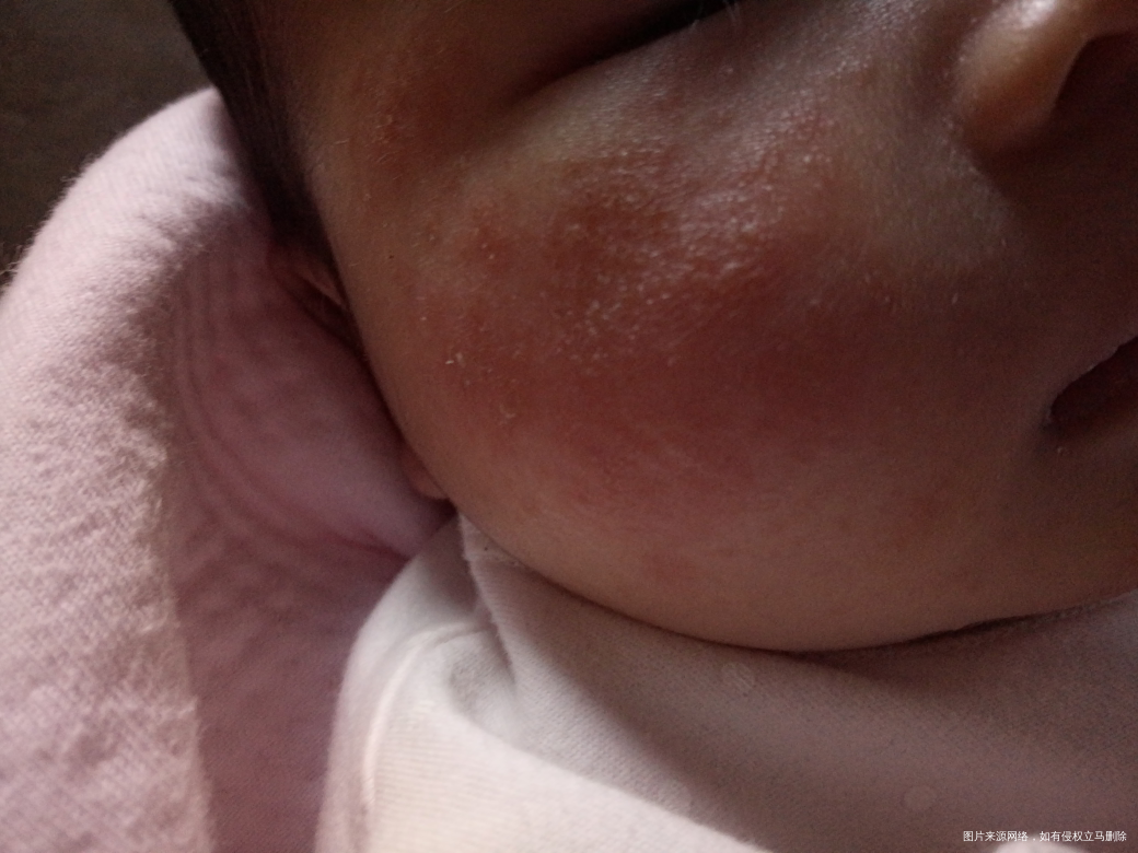 45天的宝宝脸上是湿疹吗?