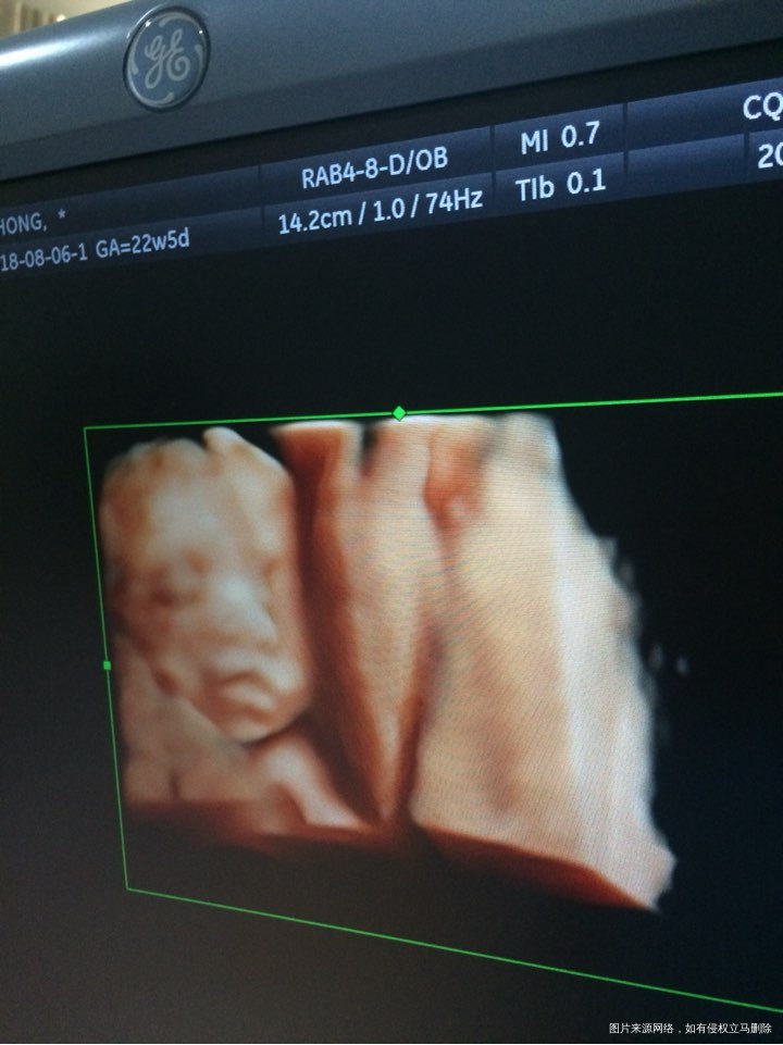 怀孕22周检查系统B超医生说我这个胎盘有点小
