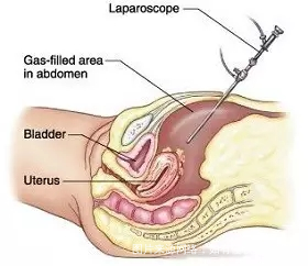 输卵管不通?这几种办法可以帮你成功怀孕!