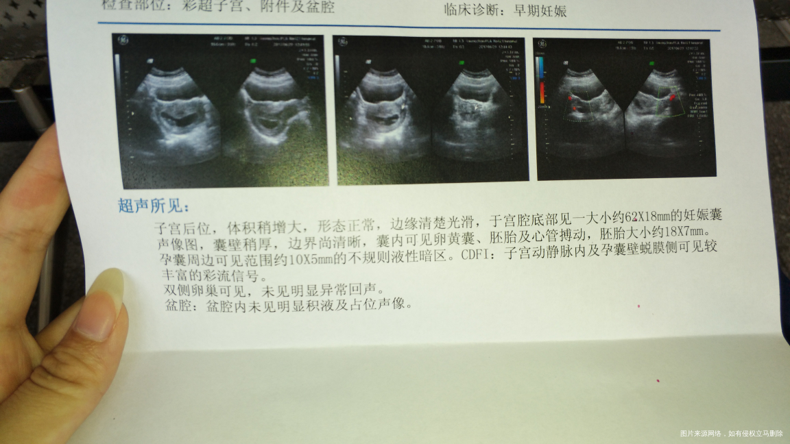 帮忙看看b超单胚胎是在宫底前壁还是后壁呢?