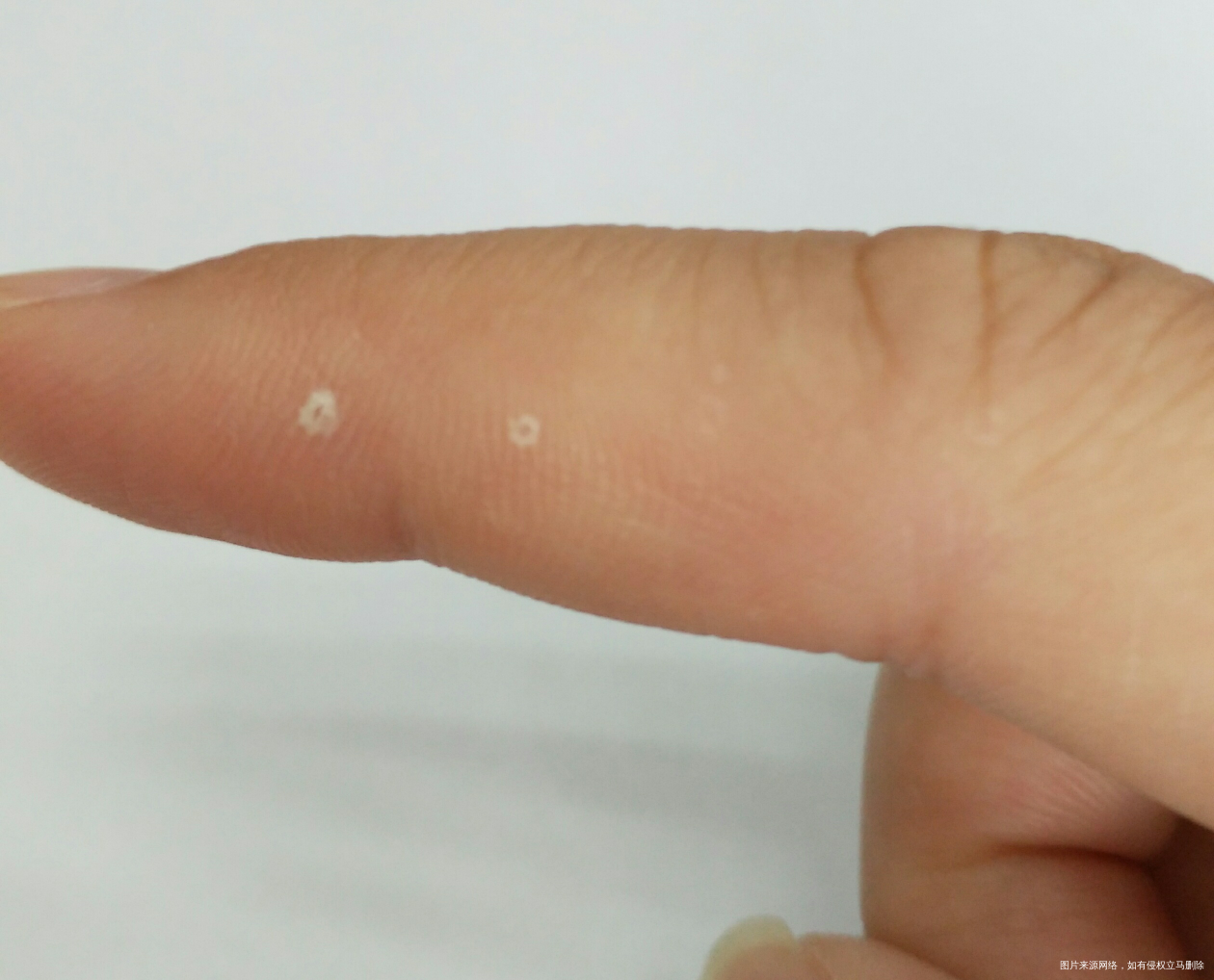 孕10周,手指掉皮,是缺乏维生素吗?