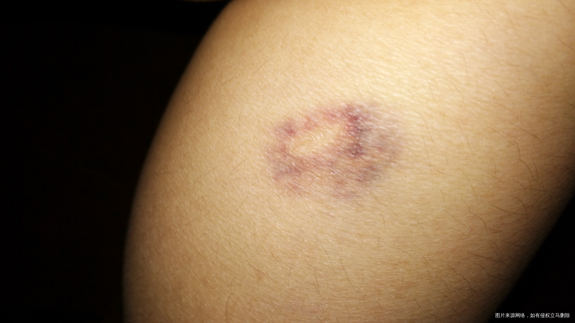 小腿淤青,不痛不痒,是因为怀孕引起的吗?