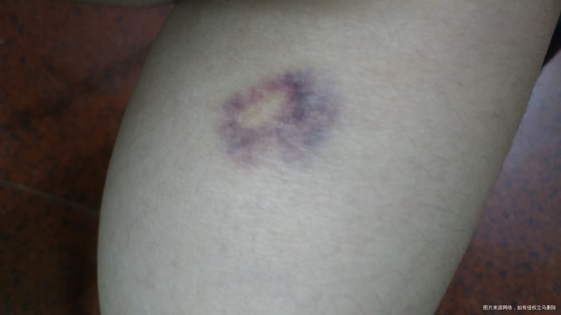 小腿淤青,不痛不痒,是因为怀孕引起的吗?