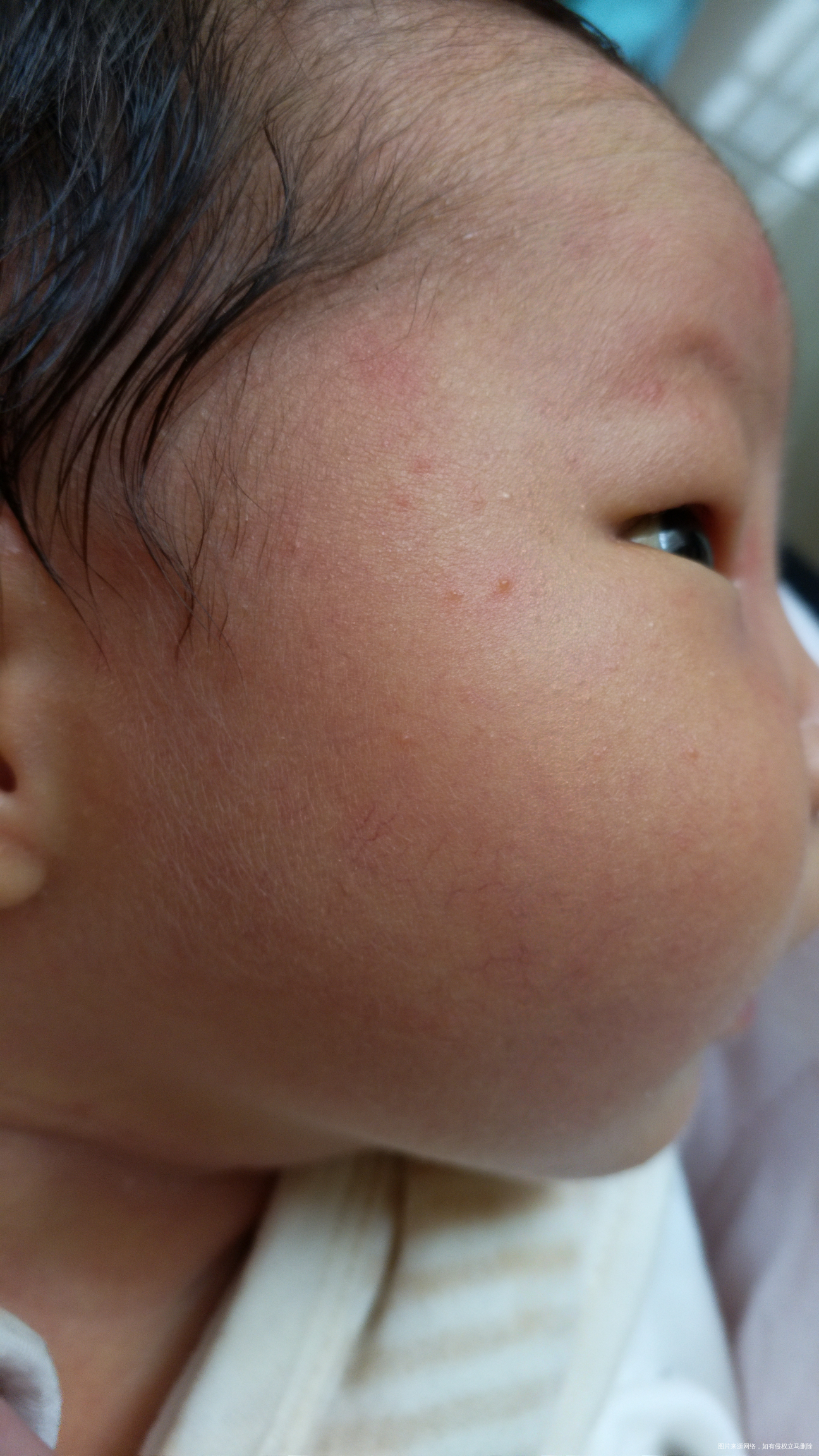 宝宝刚出生九天,脸上长的是什么?