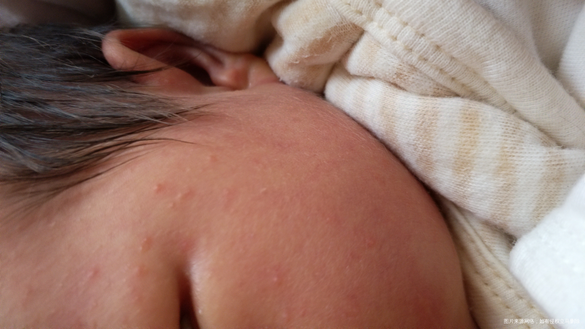 宝宝刚出生九天,脸上长的是什么?