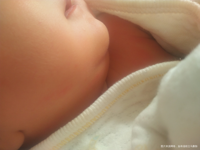 帮我看看宝宝脸颊 和肩膀都红红的是怎么了