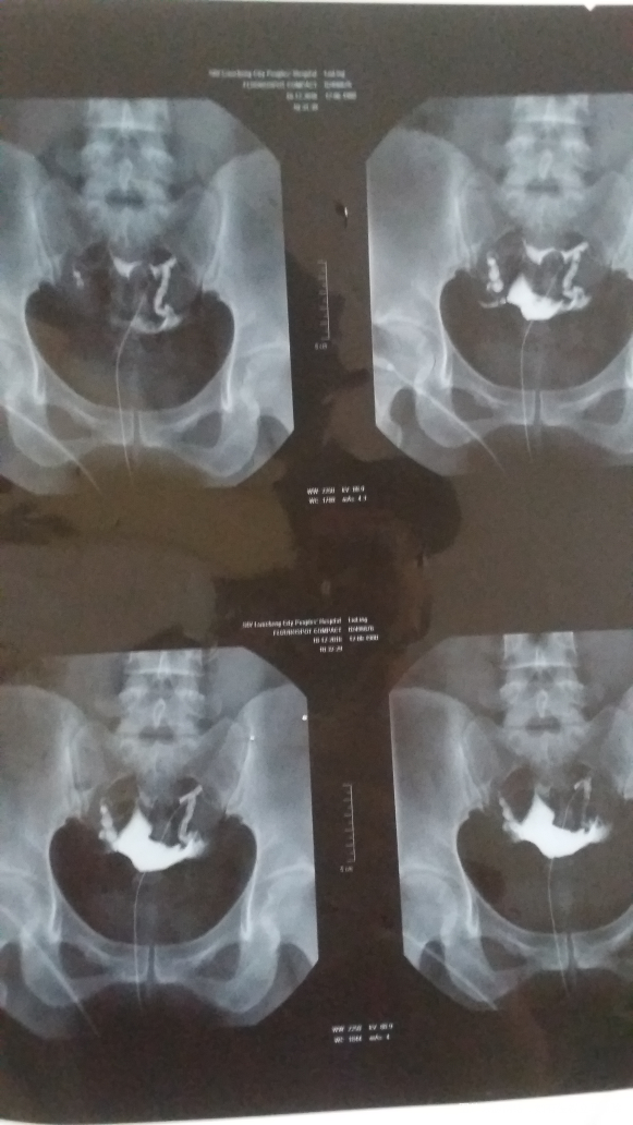 请大夫帮忙看下造影片子,需要做宫腹腔镜吗?