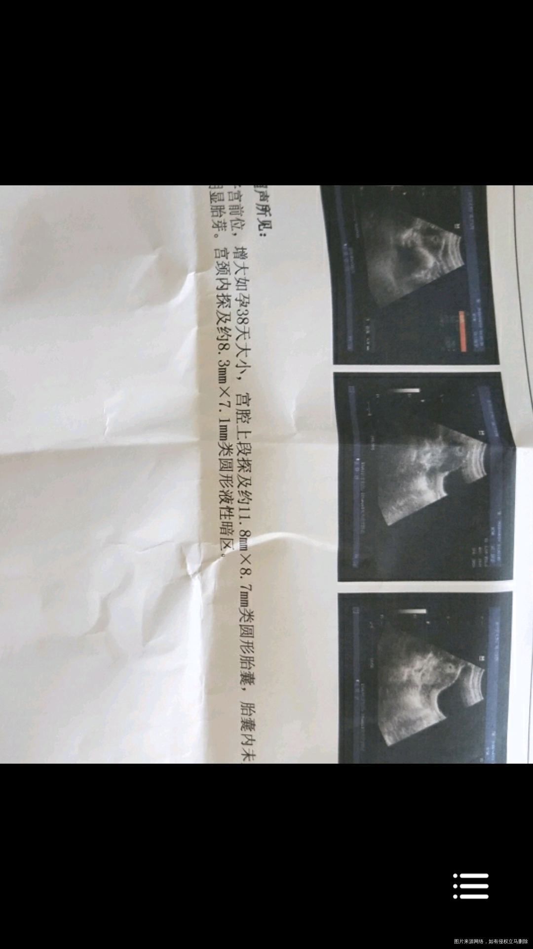 医生帮我看看,这样的b超机器可以做NT吗?