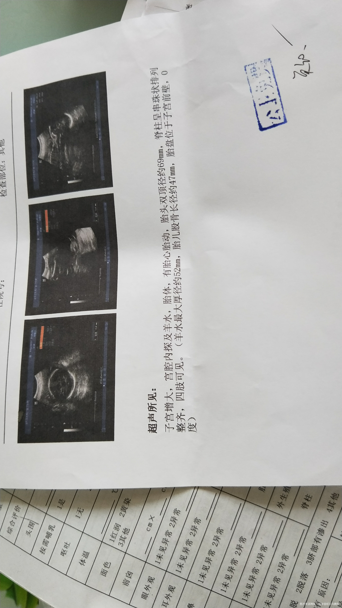 医生帮忙看看,符合多少孕周了,腿是否短了呢?