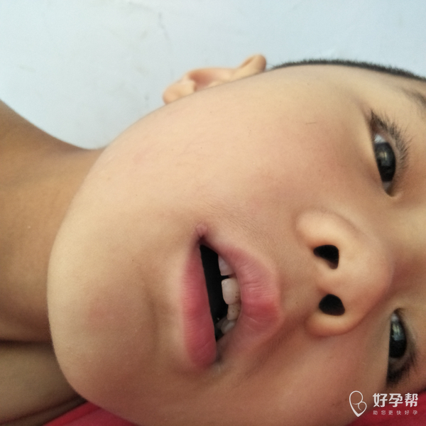 我孩子七岁长了嘴角疮