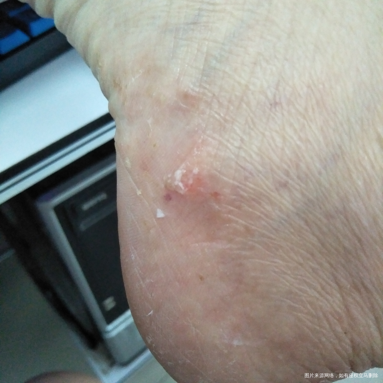 你好医生,最近脚气严重