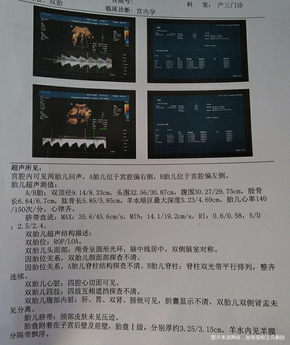 双胎38周整,这两天出现了肚子疼,肚子发硬,宝宝们可能这几天就要发动了,准备下周...