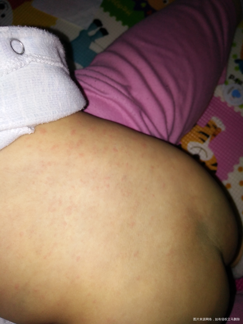 麻烦医生看看是不是出急疹