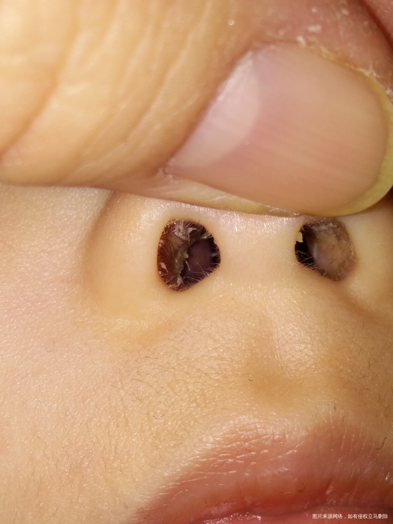 宝宝鼻孔里有个小疙瘩