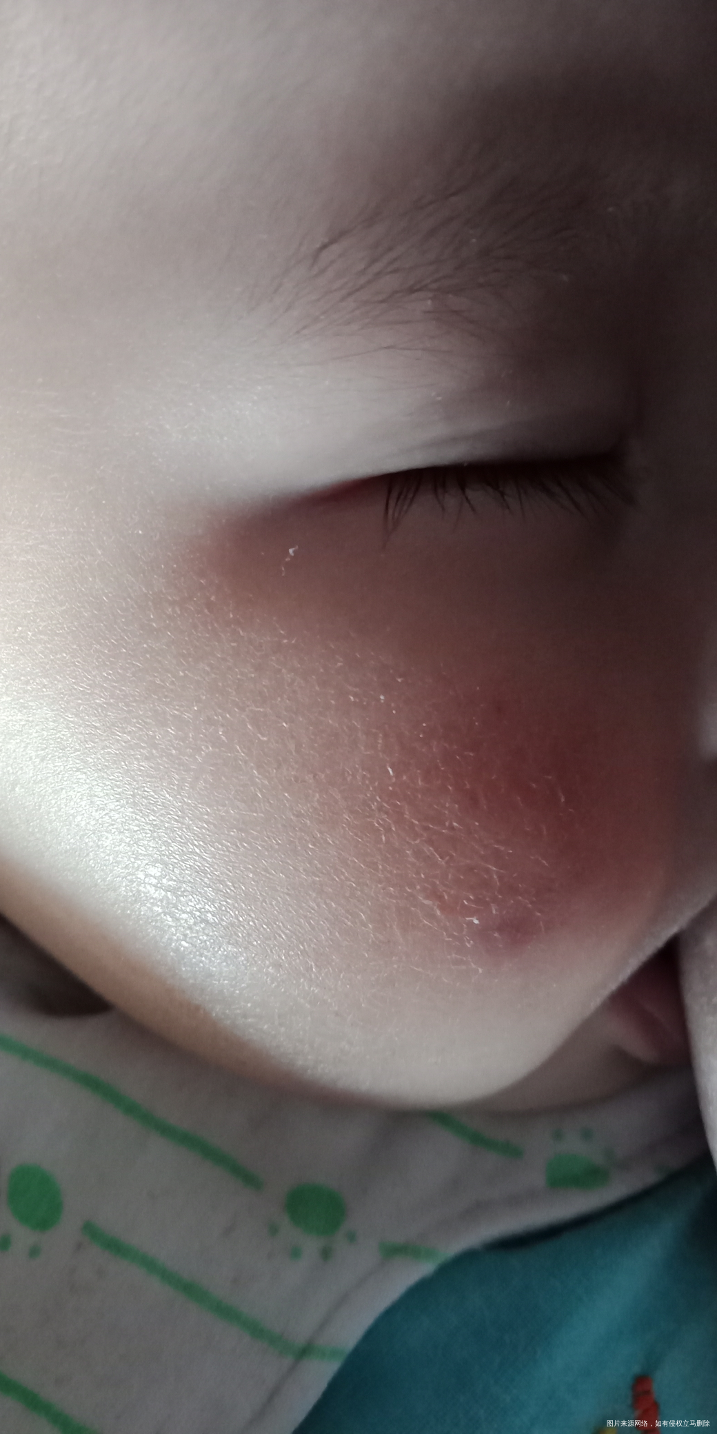 我可怜的宝,这两天腮帮成这样了