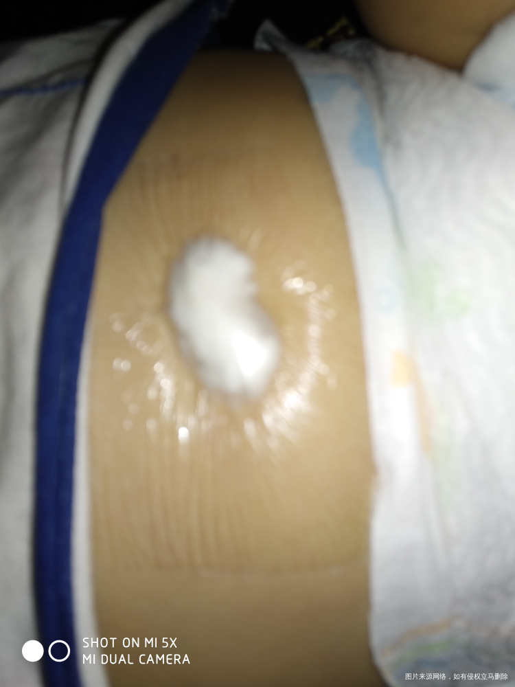 【宝宝脐疝】 +治疗方法