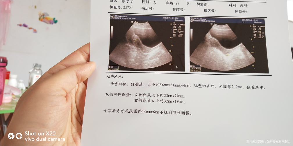 请医生帮我看下彩超单!是不是快月经了
