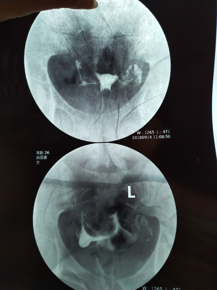 今天做了造影 医生帮我看下怎么样吧？