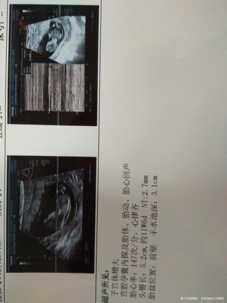 求医生帮我看下,这是今天做的nt的结果