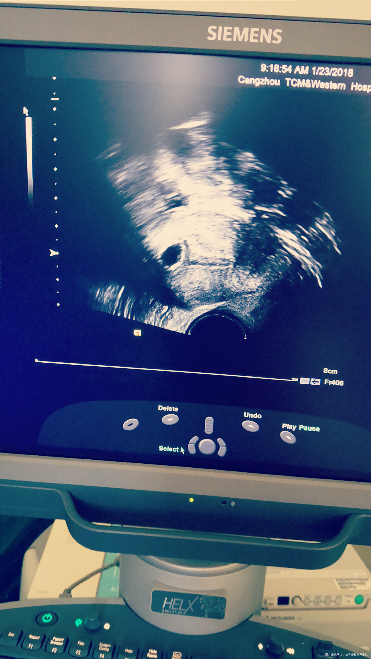 医生帮我看看有胎芽吗