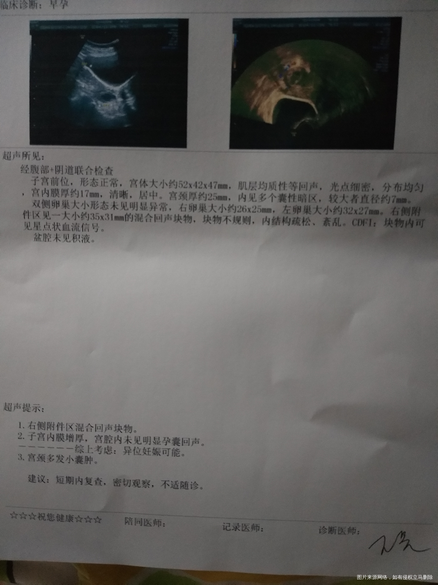 求助,请医生帮看看这是不是宫外孕?