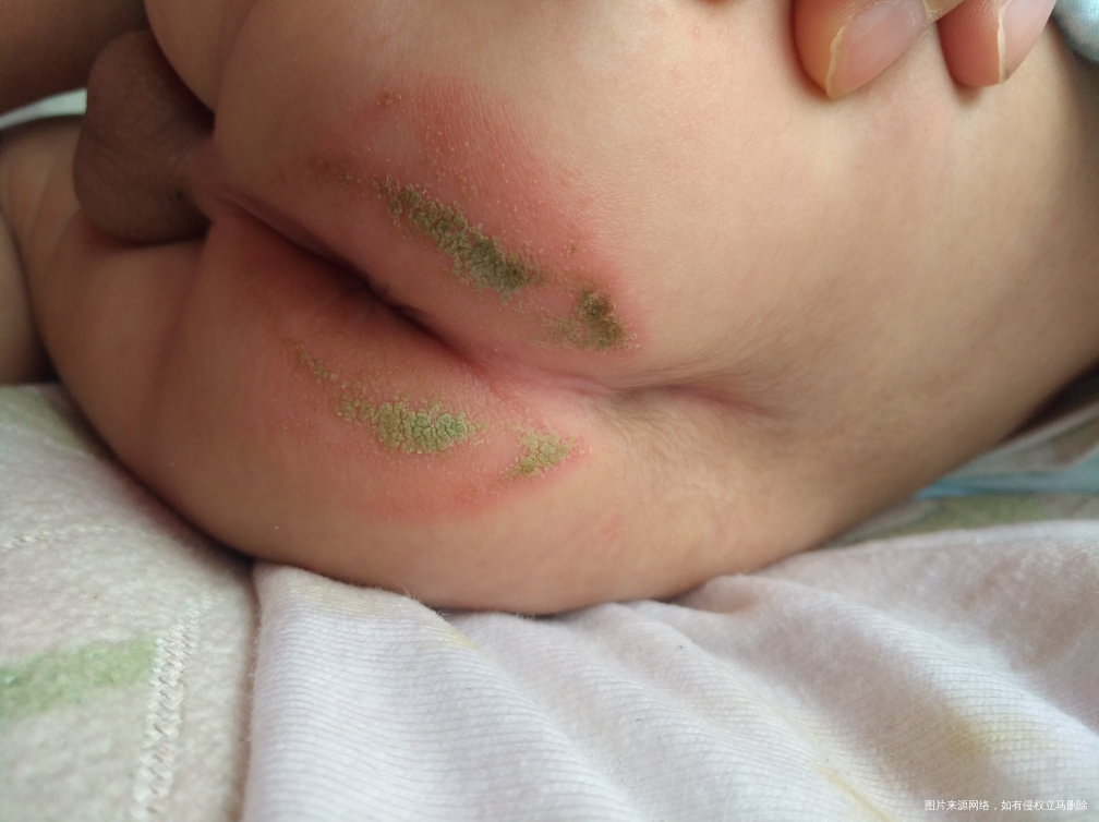 麻烦宝妈帮忙看看,宝宝红屁股求支招