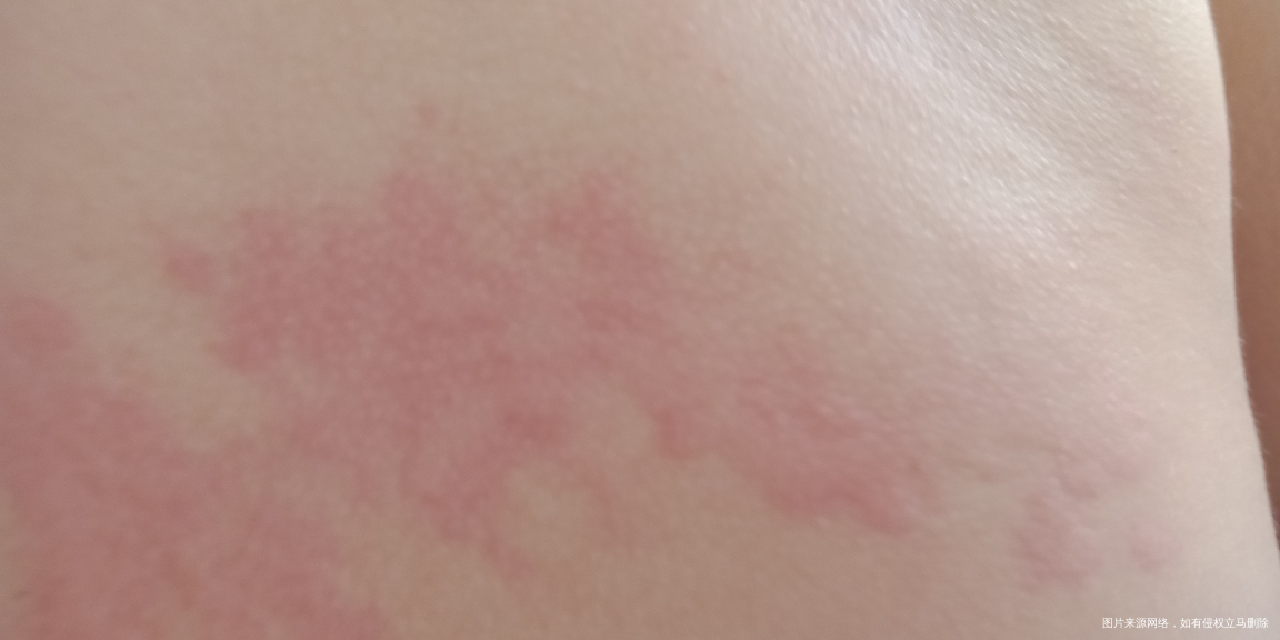 宝宝过敏严重该怎么办?