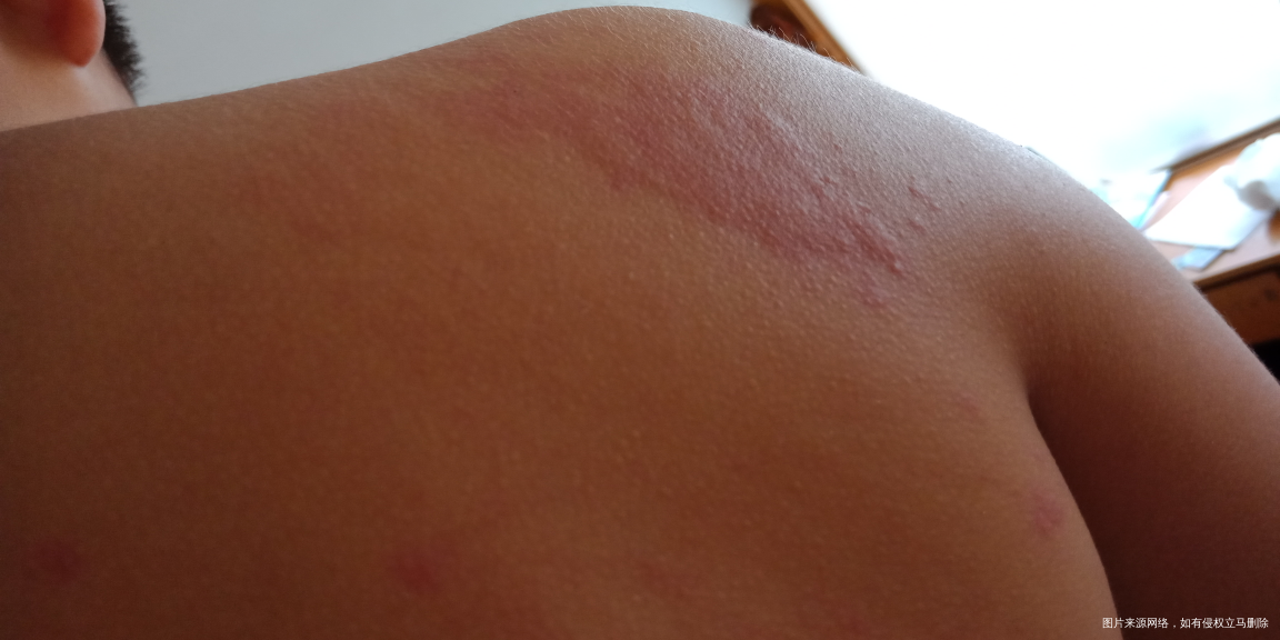 宝宝过敏严重该怎么办?