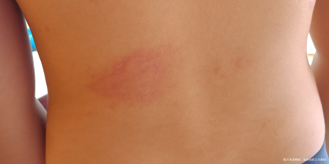 宝宝过敏严重该怎么办?