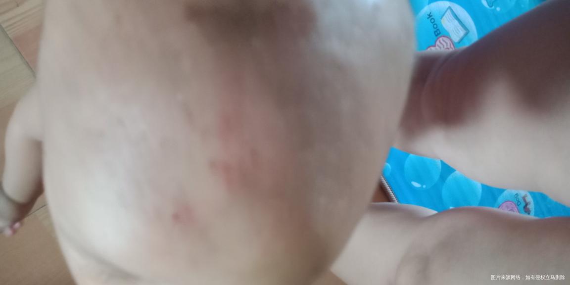 炎热的夏天孩子头上起痱子了