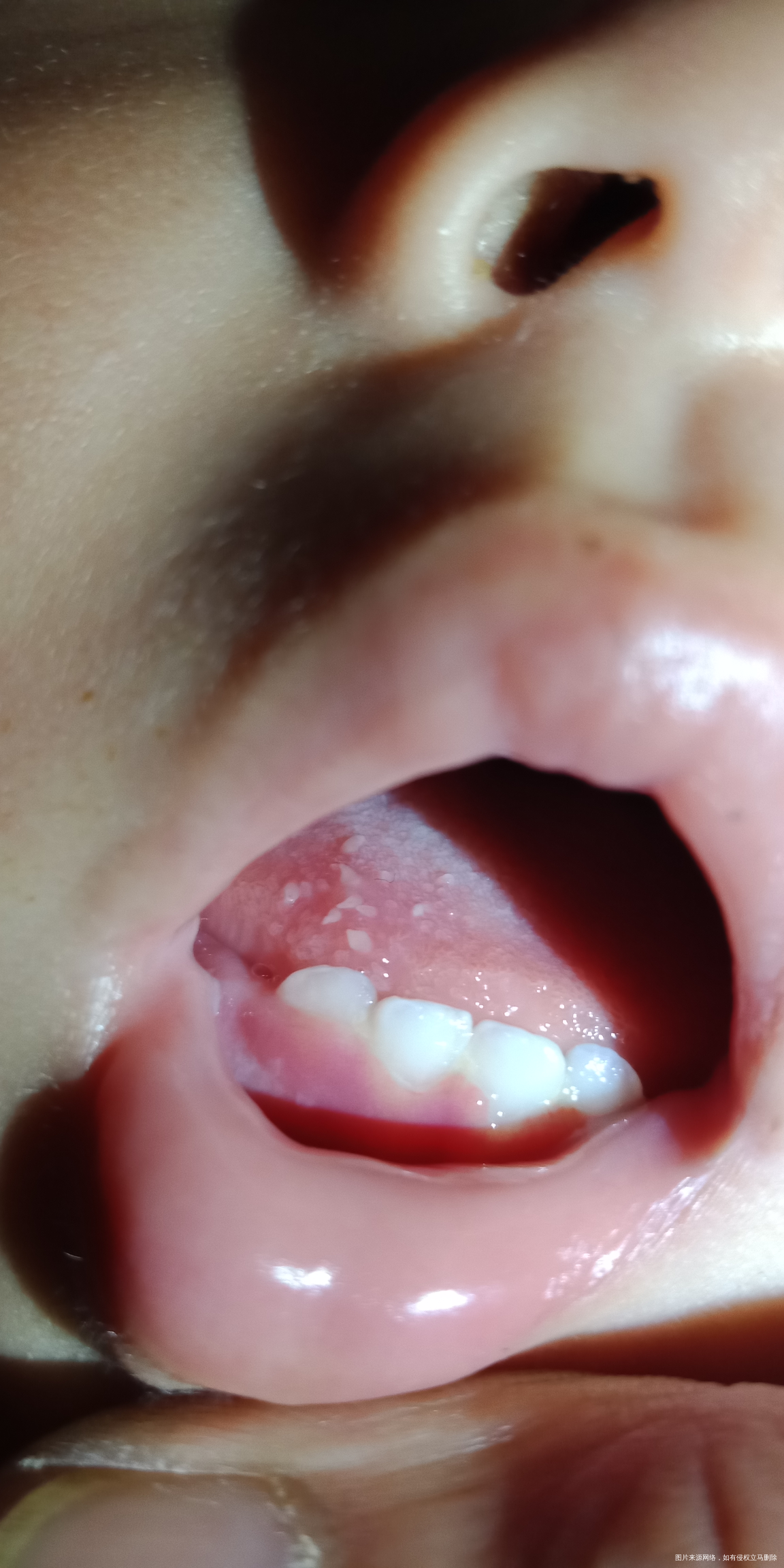 宝宝的舌头上这是什么?